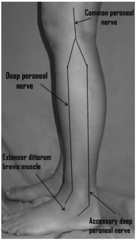 The Accessory Deep Peroneal Nerve And Anterior Tarsal Tunnel Syndrome