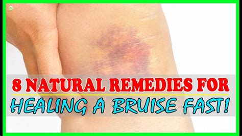 How To Get Rid Of Bruises Fast And Naturally Bruise Treatment Best