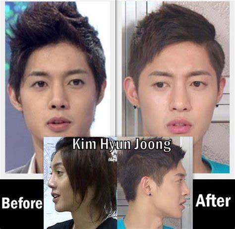 Kim Hyun Joong Nose Job Plastic Surgery Plastic Surgery Photos