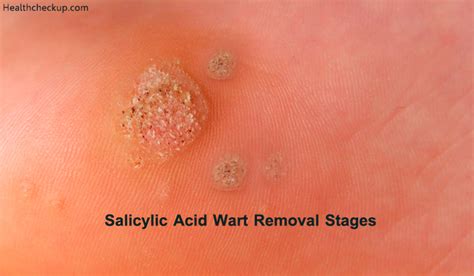 Find out what virus causes them, how they are treated, and what can be done to prevent them. Stages Of Plantar Wart Removal Using Salicylic Acid ...