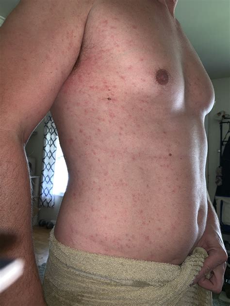 Red Itchy Spots All Over Torso And Some On Legs Not Bumpy Or Raised At