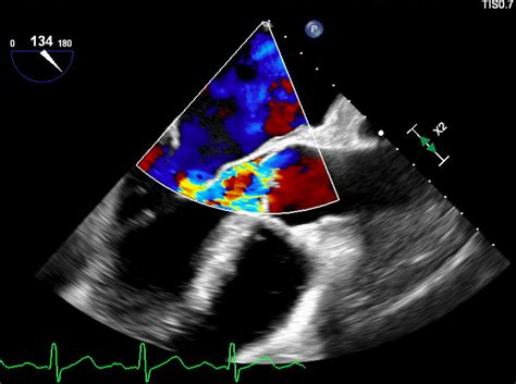 Cureus A Case Of Aortic Valve Infective Endocarditis With