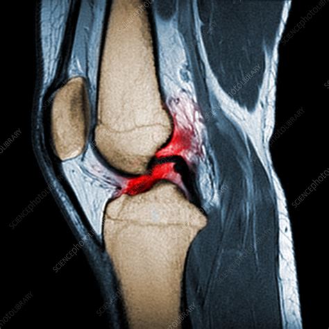 The classic signs/symptoms of acl. Torn ACL, MRI - Stock Image - C030/5928 - Science Photo ...