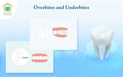 Overbites And Underbites Elite Dental Care