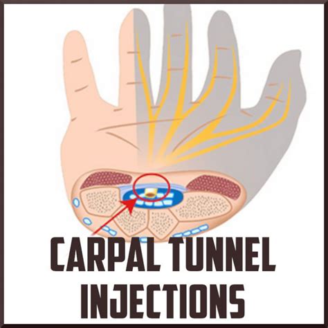 Carpal Tunnel Injections Sports Medicine Review