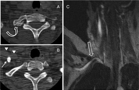 Cervical Ribs Identification On Mri And Clinical Relevance Clinical