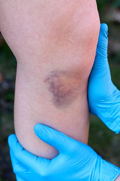 People Accident Scar Human Leg Stock Photos Pictures And Royalty Free
