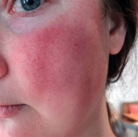 Collection 102 Pictures The Cause Of Rosacea Is Unknown Sharp