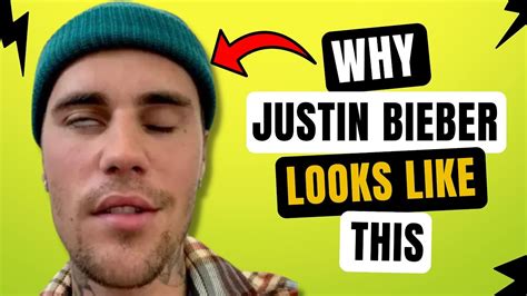 Justin Bieber’s Facial Paralysis Explained What Is Ramsay Hunt Syndrome Youtube