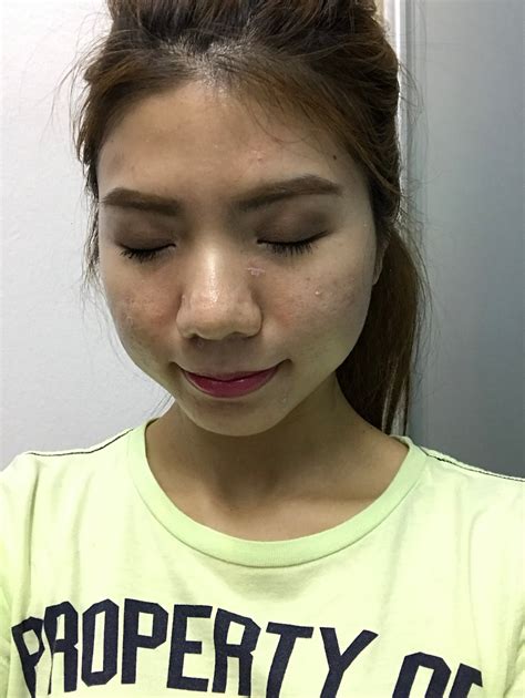 Best dermatologist, skin specialist and skin clinics in kuala lumpur. Q-Switched Laser and Shining Peel at Skin Gym Laser Clinic ...