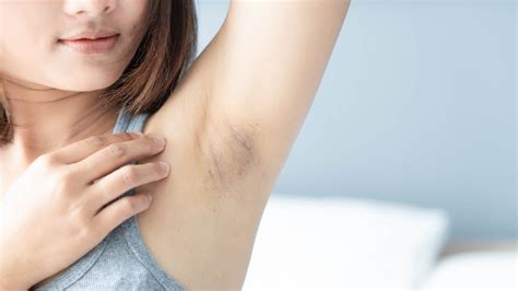Dealing With Dark Underarms Here S How To Get Rid Of The Issue