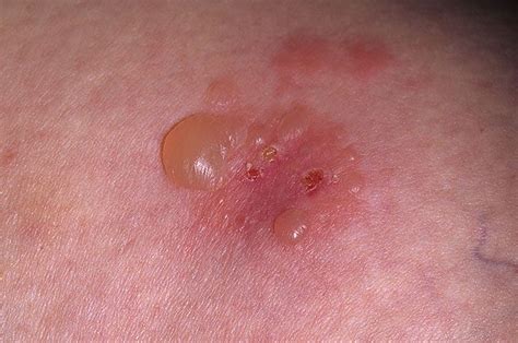 Celiac Disease Has A Little Sister Dermatitis Herpetiformis