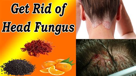 Scalp Fungus Natural Treatment How To Get Rid Of A Fungal Scalp