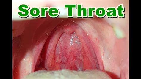 normal vs sore throat pharyngitis youtube
