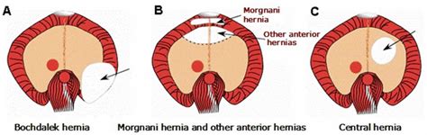 Diaphragmatic Hernia Causes Symptoms Diagnosis Treatment And Prognosis