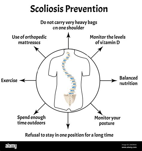 Prevention Of Scoliosis Spinal Curvature Kyphosis Lordosis Of The