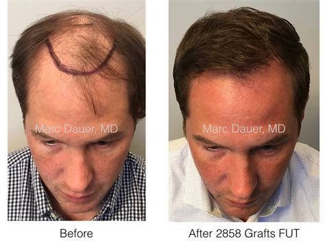 New Patient Video Testimonial Marc Dauer MD Hair Transplant Doctor