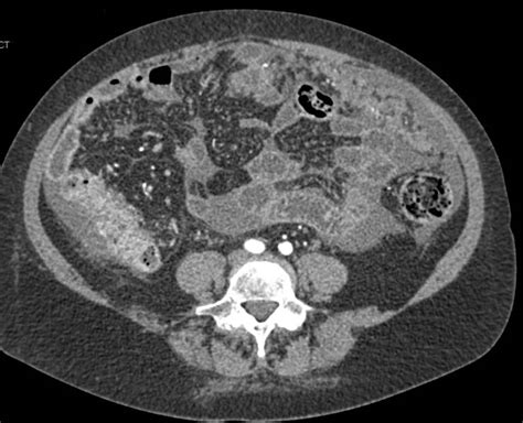 Ovarian Cancer With Carcinomatosis Obgyn Case Studies Ctisus Ct