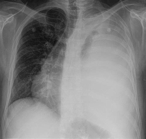 Maybe you would like to learn more about one of these? Pleuraerguss - Transsudat oder Exsudat? Pathologie ...