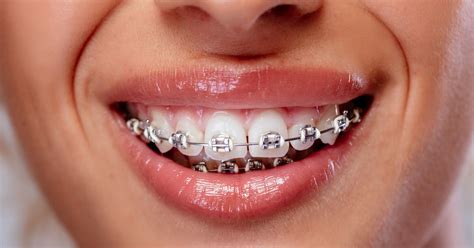 Removable Orthodontic Appliances Treatment With Aligners 🦷