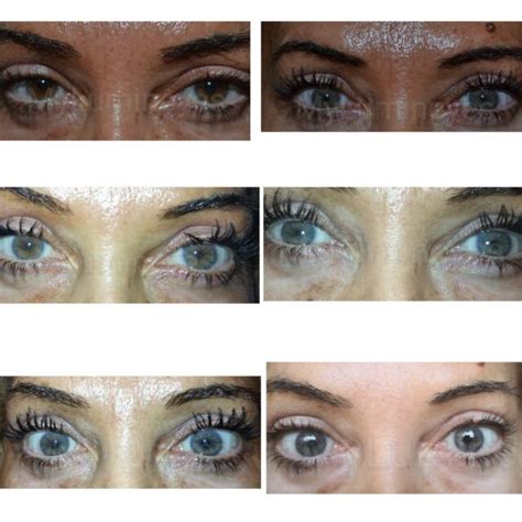 Eye Color Laser Surgery Cost And Guide