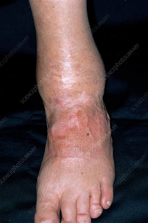 Arthritis Of The Ankle Stock Image M1100521 Science Photo Library