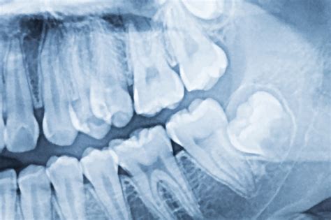 His dentist offered them to him, but he didn't want them and the dentist told him they are more trouble. Wisdom Tooth Removal Pain | Top-Rated Dental Clinic in Toronto