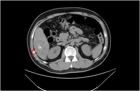 The Abdominal Enhanced Contrast Computed Tomography Ct Revealed A