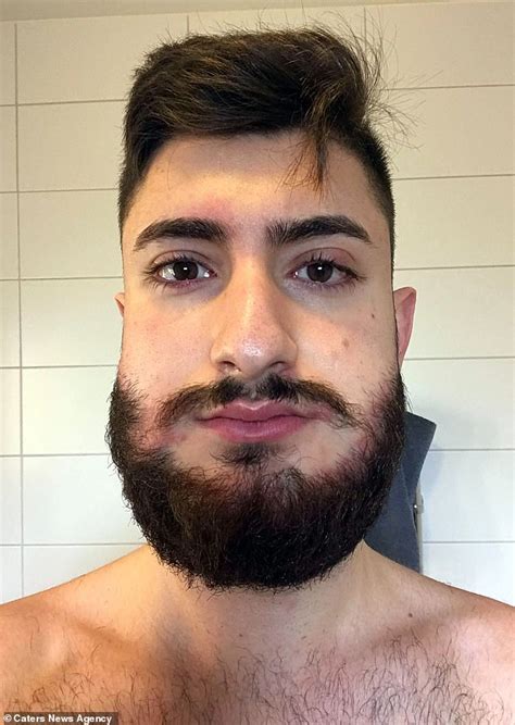 Swedish Mans Face Balloons After He Dyed His Beard And