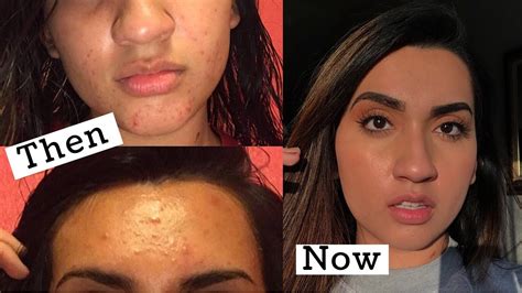 How I Cleared Up My Skin My Acne Story Youtube