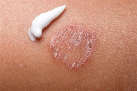 Common Skin Rashes With Pictures