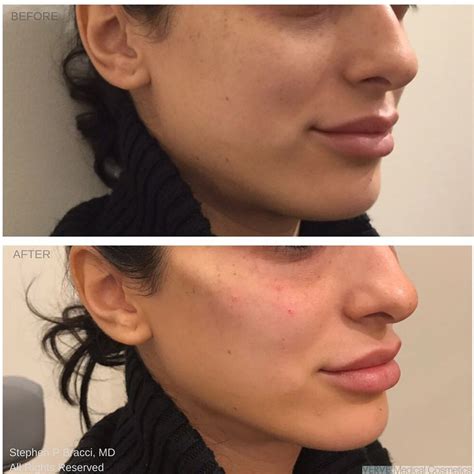With cheek fillers, hollow gaunt cheeks are a thing of the past. Jawline and cheek contour | Cheek contour, Cheek fillers ...