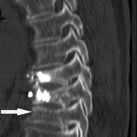 Ct Scan Of The Thoracic Spine In A 79 Year Old Woman Who Underwent