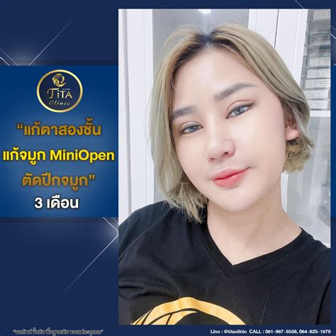 แก้ตาสองชั้น แก้จมูก mini open... - ฑิตาคลินิก เวชกรรม