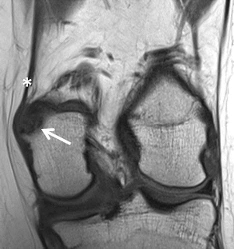 Distal Femoral Cortical Irregularity At Knee Mri Increased Prevalence