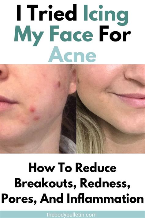 I Tried Ice On My Face For Acne Heres What Happened • The Body