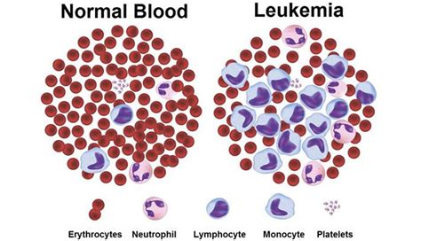 Leukocytosis Symptoms Causes And Treatments New Life Ticket Part 9