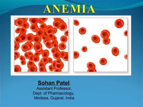 Final Anemia Ppt