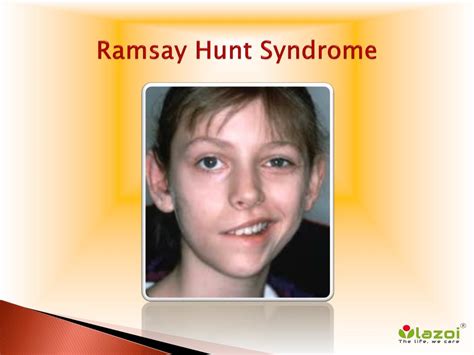 Ramsey Hunts Syndrome Ramsay Hunt Syndrome Wagner 2012 Jddg