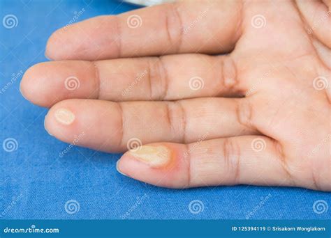 Blister From The Heat Injury Stock Image Image Of Infection Burn