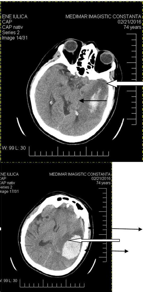 Figure 2 Preoperative Ct Scan Acute Left Fronto Temporoparietal