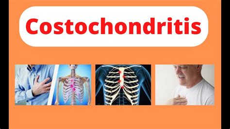Costochondritis Rib Cage Inflammation Causes Symptoms And Treatment