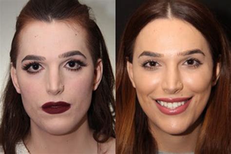 Facial Feminization Surgery In Toronto Solomon Facial Plastic