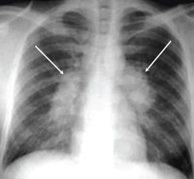 Tb Chest X Ray Chest X Ray Showing Normal Chest And Pulmonary