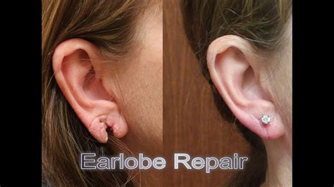 Ripped Stretched Split Injured Torn Earlobe Repair With Laser Plastic