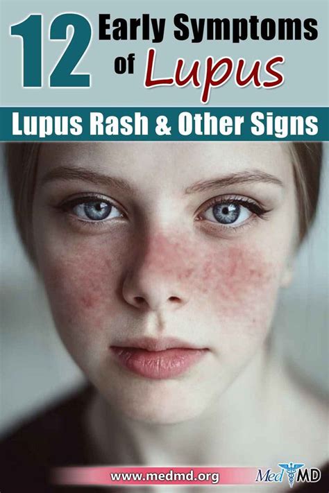 12 Early Symptoms Of Lupus Lupus Rash And Other Signs Lupus Rash
