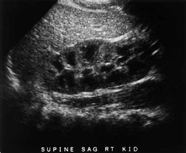 Normal Neonatal Kidney Ultrasound