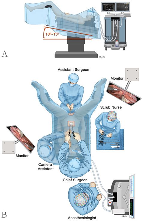 Surgical Positioning And Operating Room Setup For Laparoendoscopic