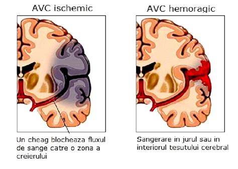 Accidentul Vascular Cerebral AVC Neurologie Pediatrica
