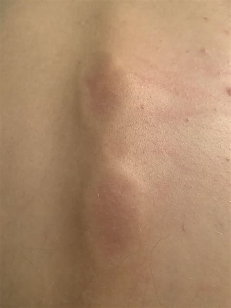 Lumps found on spine with back pain. 2 months ago tried climbing a tree